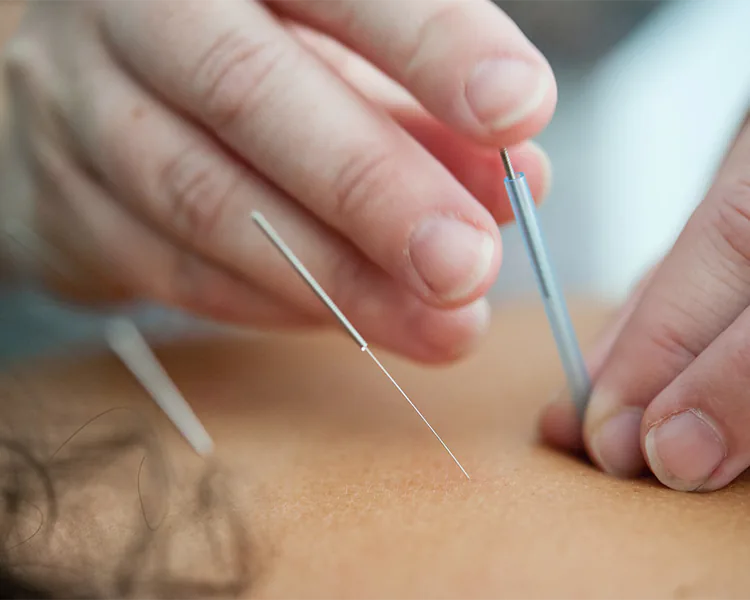Atendimento de acupuntura domiciliar